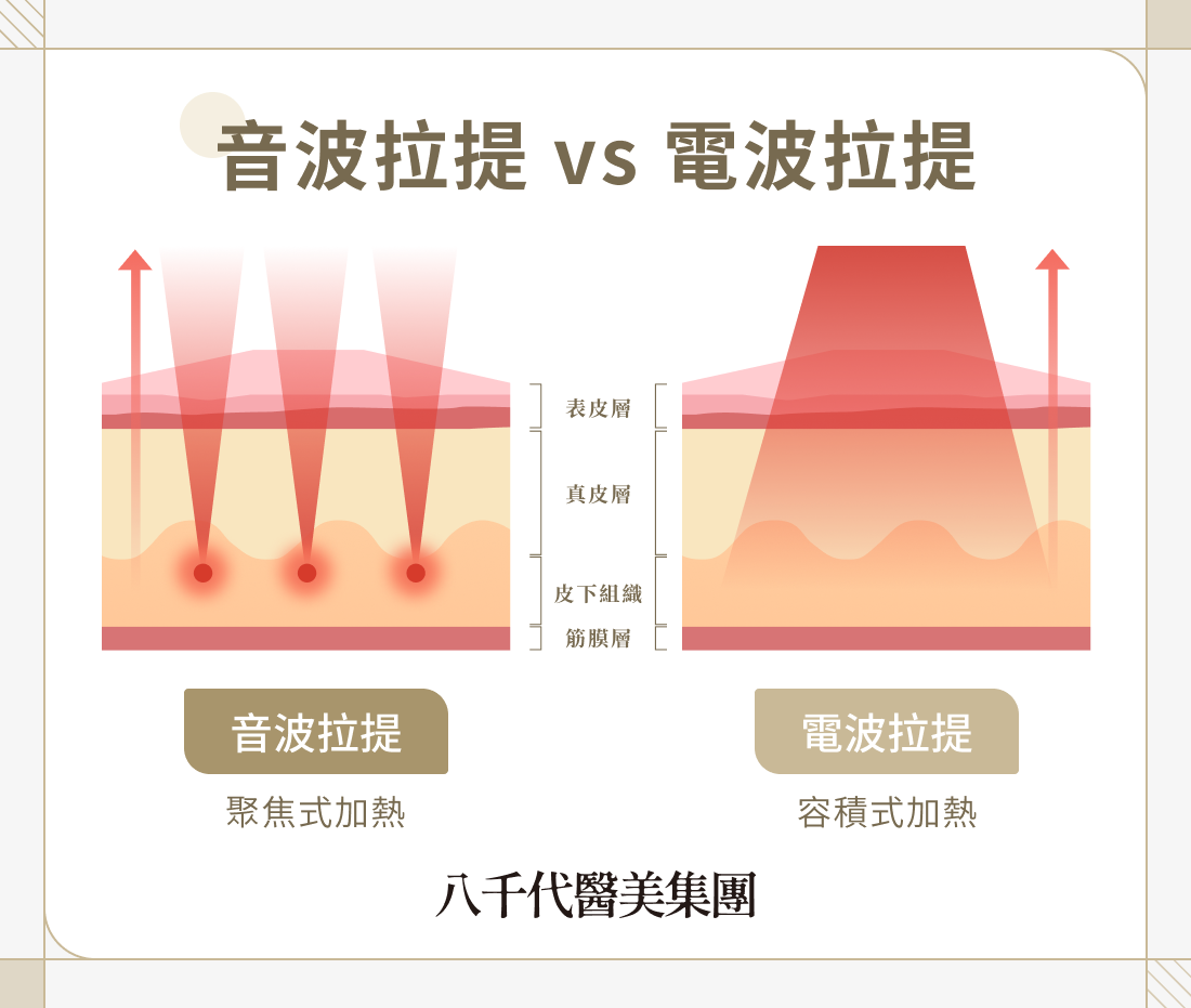 音波拉提 vs 電波拉提