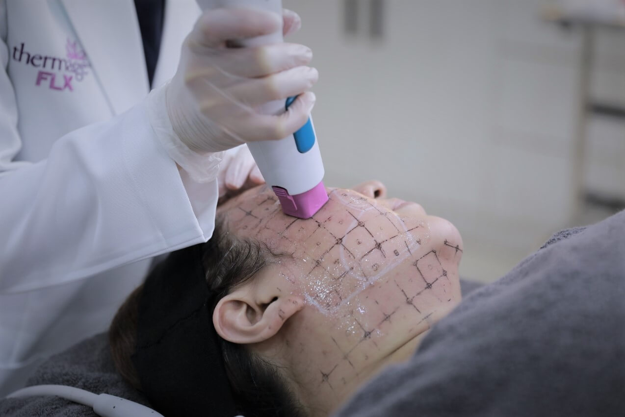 紫鑽探頭施打鳳凰電波臉部示意圖