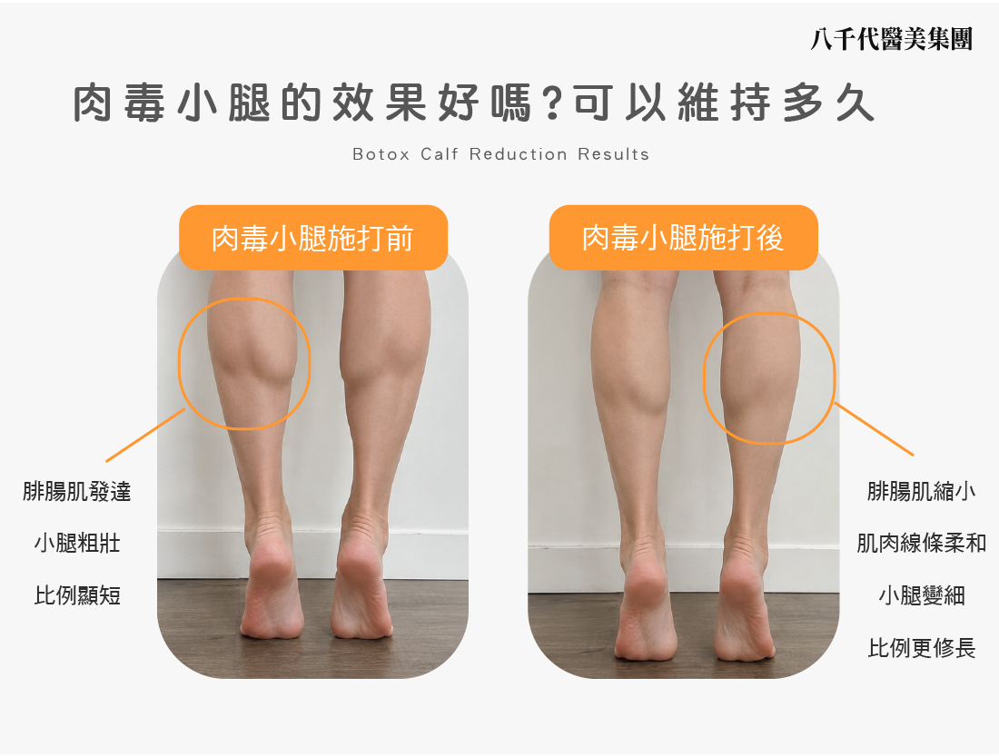 Botox Calf Reduction Results