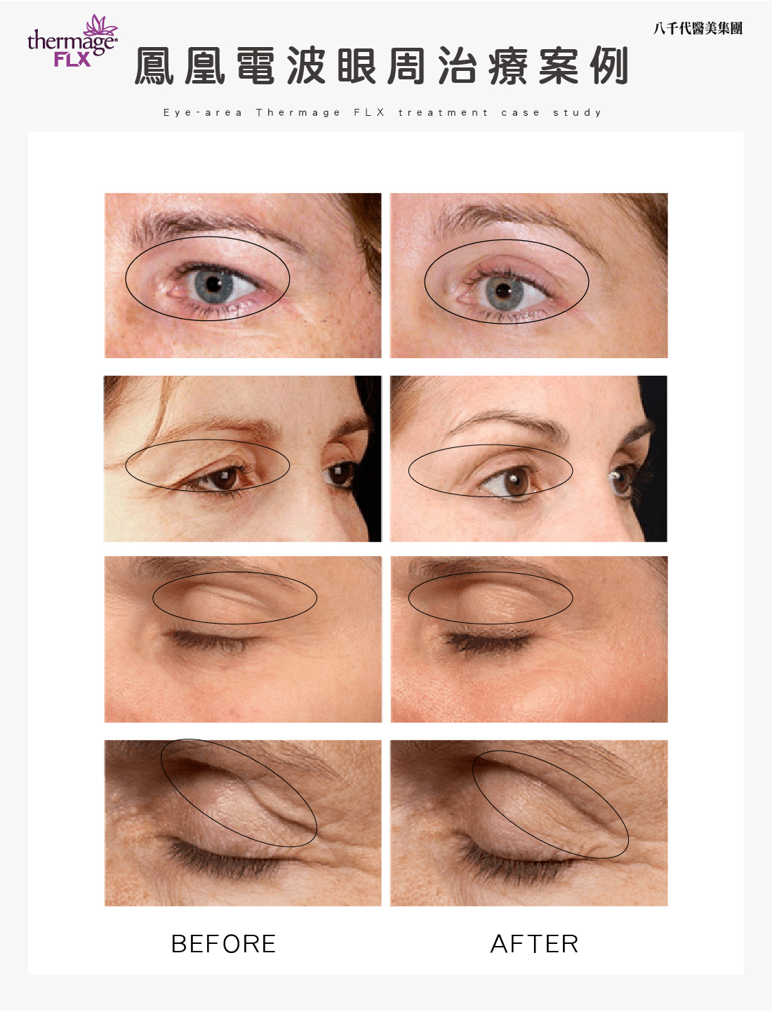 鳳凰電波眼周治療案例