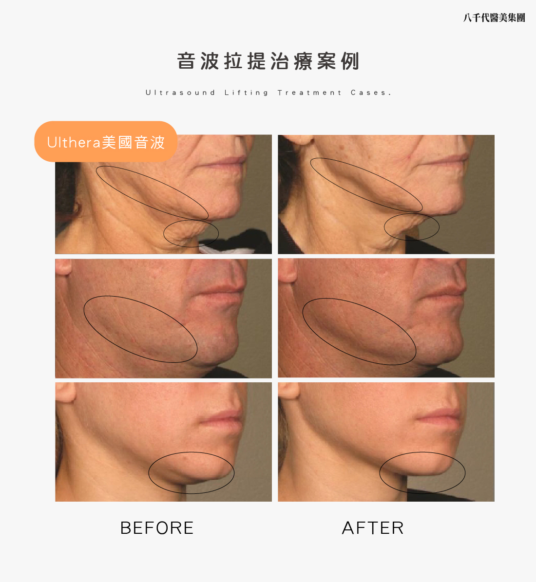 音波拉提治療案例