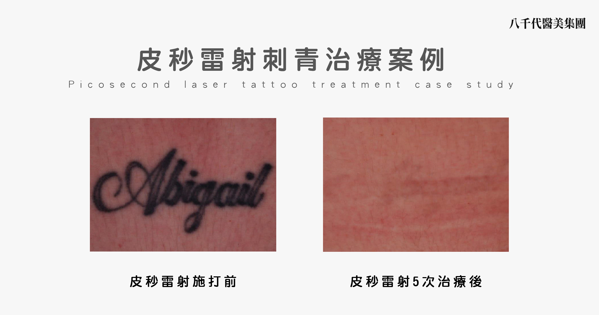 皮秒雷射刺青治療案例