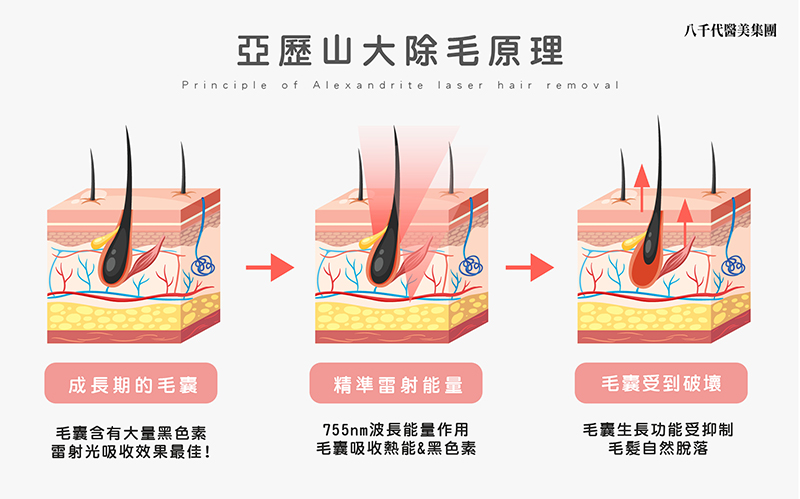 亞歷山大除毛原理