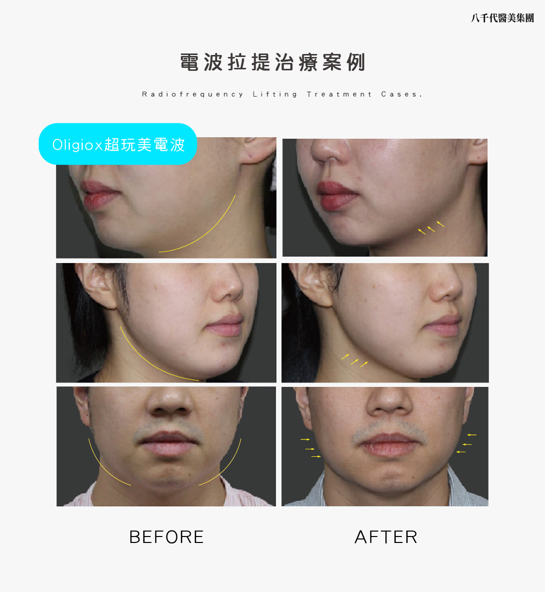 電波拉提治療案例