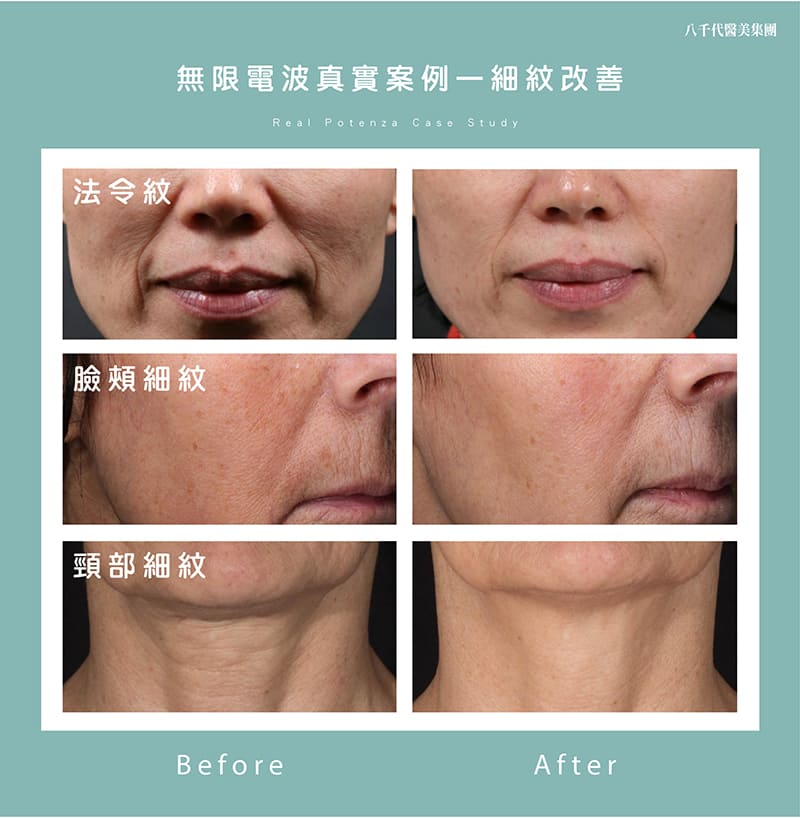 無限電波實際案例-細紋改善