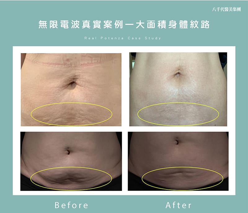 無限電波實際案例-身體紋路