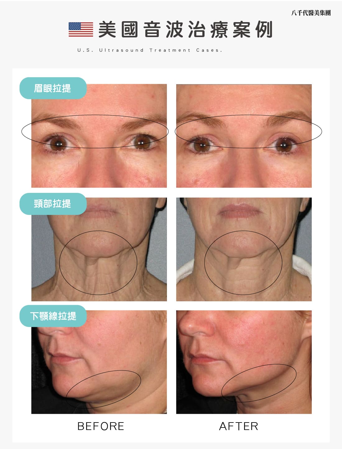 美國音波治療案例-01