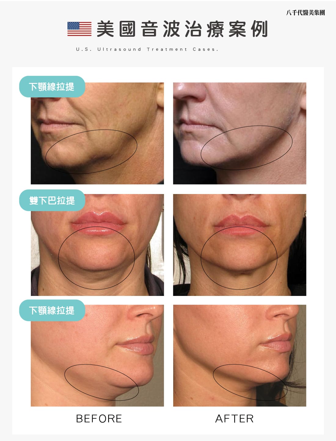 美國音波治療案例02