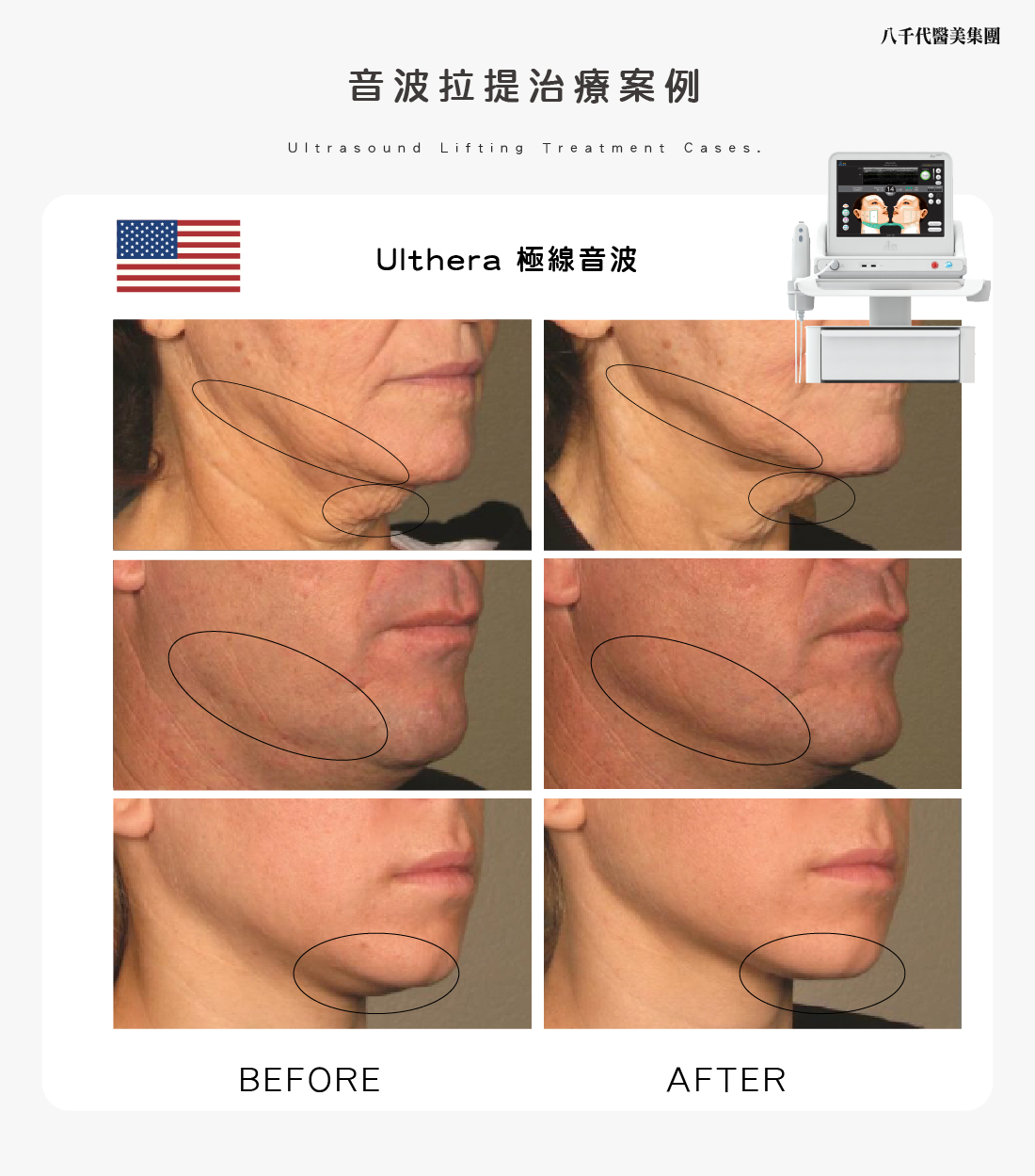 音波拉提治療案例