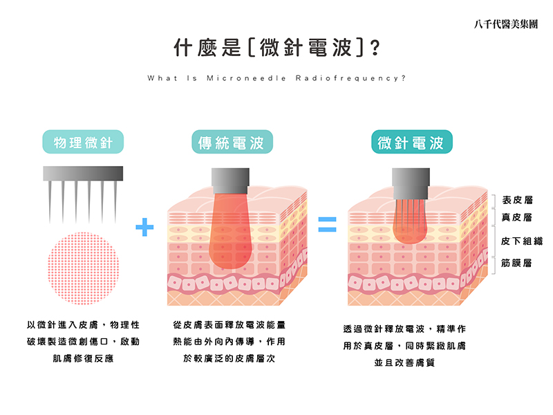 什麼是微針電波