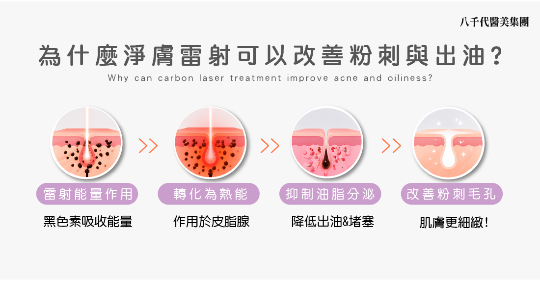 為什麼淨膚雷射可以改善粉刺與出油?