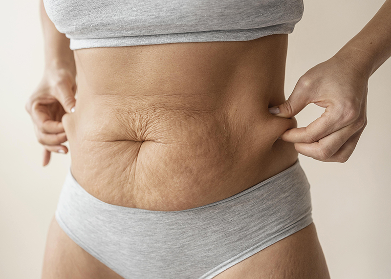 肌膚下垂示意圖