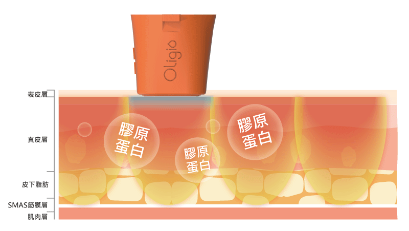 玩美電波治療深度